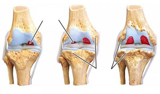 grades-arthrose