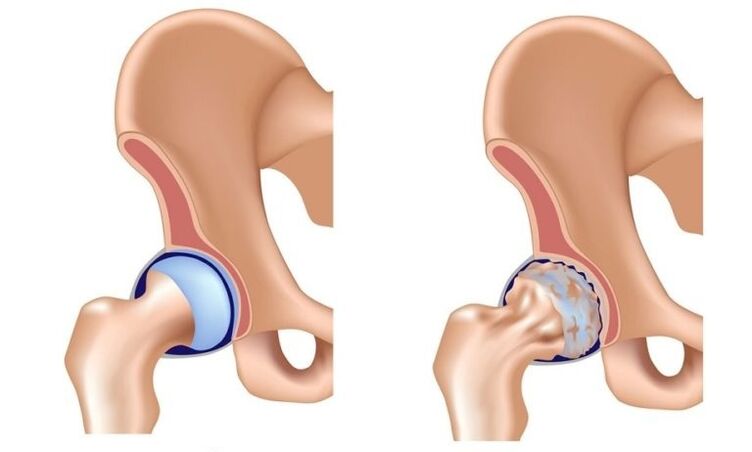 Joint sain et articulation avec arthrose