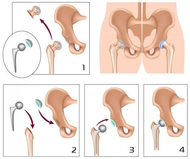 Remplacement d'un articulation douloureuse par une prothèse