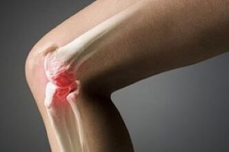 L'arthrose de l'articulation du genou est une blessure du tissu du cartilage