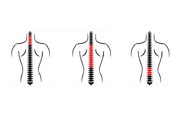 Comment se manifeste l'ostéochondrose