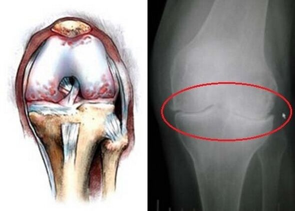 arthrose de l'articulation du genou
