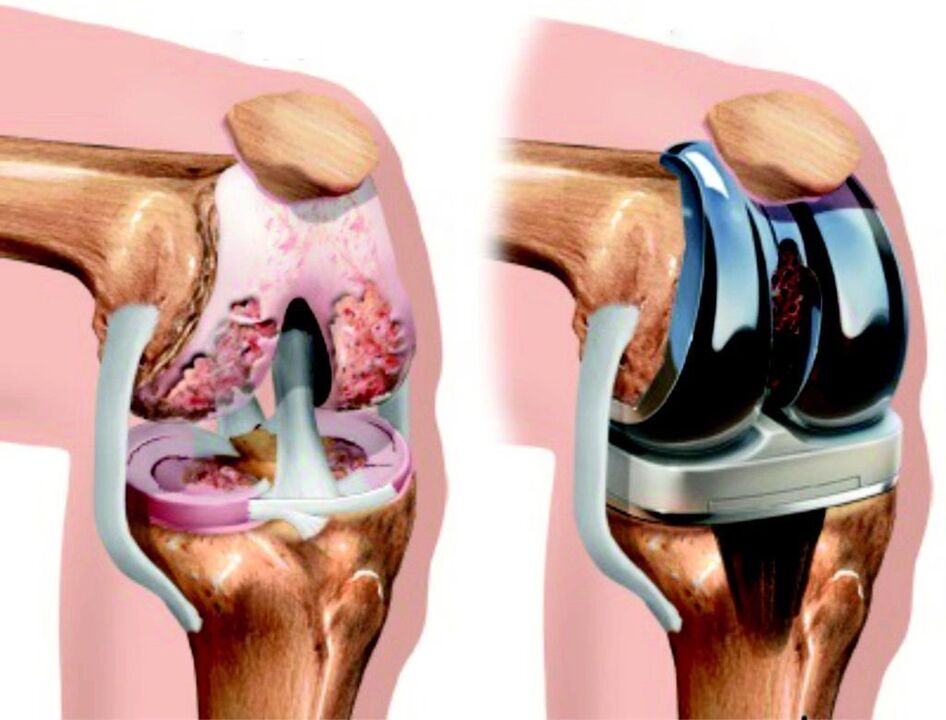 En cas de lésion totale de l'articulation du genou causée par l'arthrose, il est possible de la restaurer à l'aide d'endoprothèses